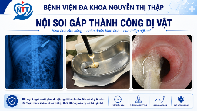 NỘI SOI GẮP THÀNH CÔNG DỊ VẬT KỀM BẤM MÓNG TAY TRONG DẠ DÀY NGƯỜI BỆNH